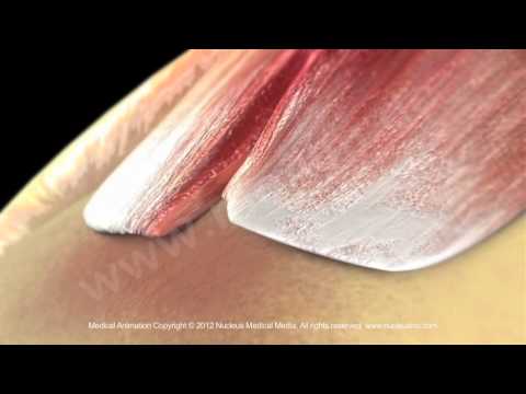 Rotatorenmanschettenriss - Ruptur Supraspinatus Sehne - Diagnose Riss Rotatorenmanschette