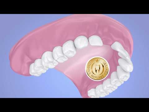 Zahnersatz: Klammerprothese mit Gaumenplatte