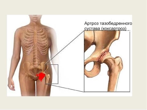 Контрактура коленного сустава википедия Куда обратиться когда болят суставы