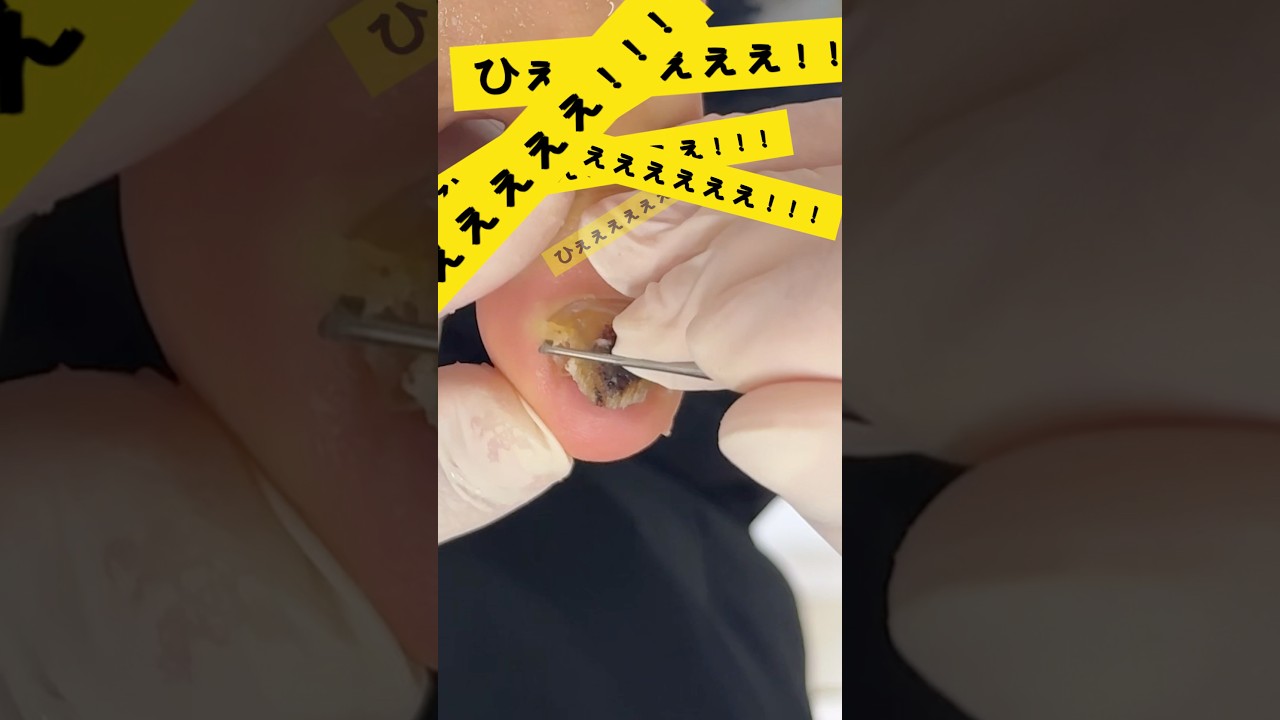 【肥厚爪ケア】#shorts