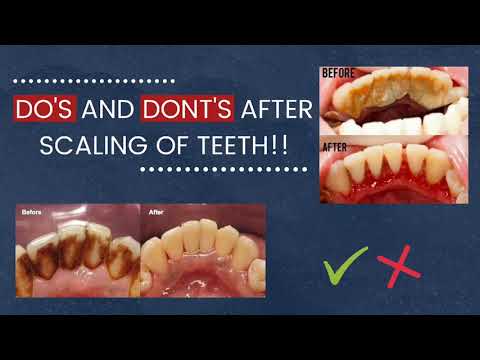 1st YouTube video about how long after dental cleaning can i eat