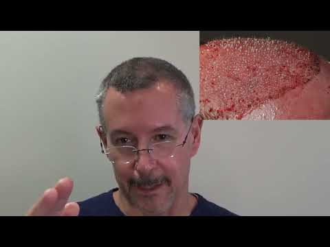 Fixing another failed fine hair FUE--2697 graft repair case in detail Dr. Lindsey | Washington | DC thumbnail