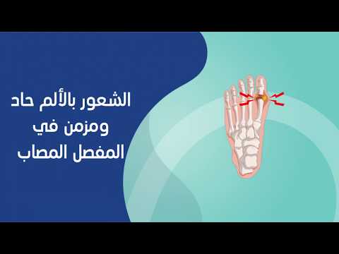 أعراض التهاب المفاصل- فيديو