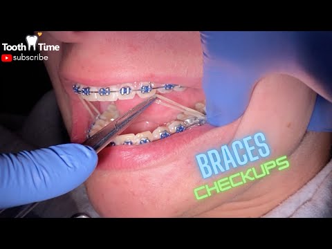 Braces Checkups |1 YEAR| First time getting Rubber bands - Tooth Time Family Dentistry New Braunfels