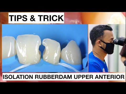Tips and Trick Isolation With Rubberdam Upper Anterior Without Clamp
