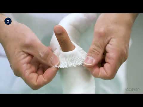 Radial gutter splint