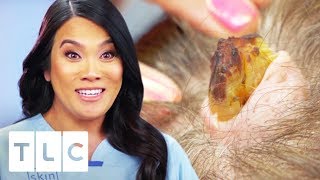 Removing A Horn-Like Growth And 6 Cysts From Woman&#39;s Head | Dr. Pimple Popper
