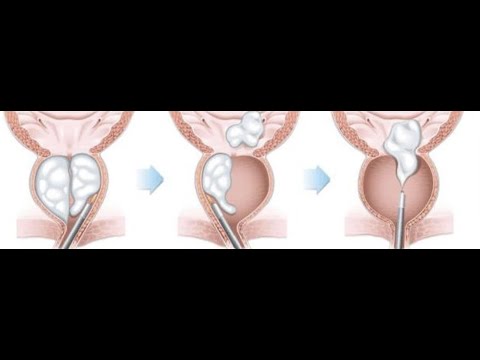 Episode 37: HoLEP: The New Gold Standard in Surgical Treatment for BPH