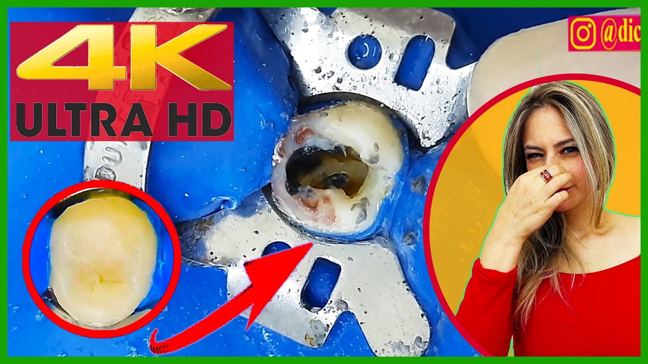 🟢 IMPRESSIVE: DEEP CARIES Removal in 4K 😱😱Dentist removes cavities in ROTTEN TOOTH!!