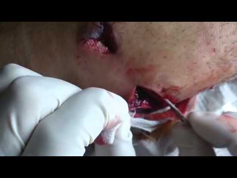 اصابة أحد عناصر كتيبة راية الإسلام برصاصة قناص في ريف دمشق