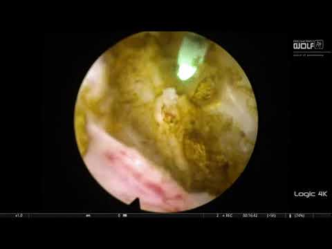 EN BLOCK ENUCLEATION PROSTATE THULEP REVOLIX