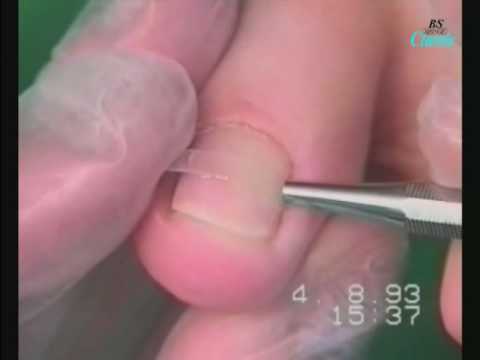 Az injekciók segítik az ízületi fájdalmakat