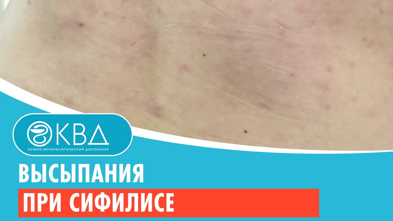 💣 Высыпания при сифилисе. Клинический случай №195