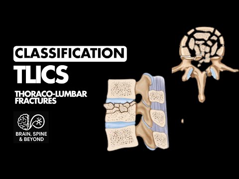 TLICS Classification Thoracic Lumbar Fractures - All What You Need to Know