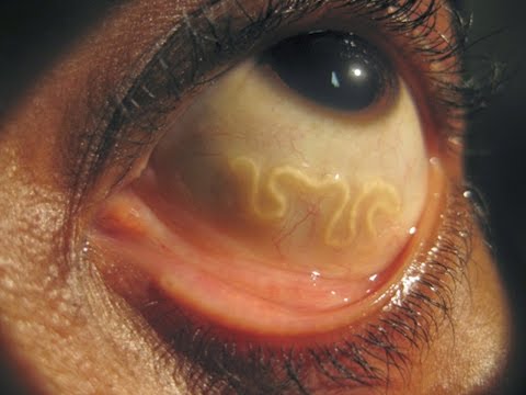 Se è possibile mangiare a sangue che fa sondaggi alla ricerca di lyambliya Che accettare alladulto da helminths