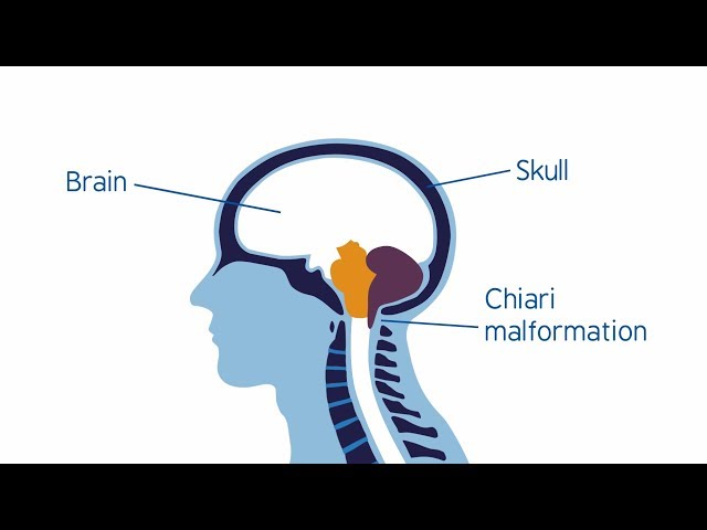 İngilizce'de chiari malformation Video Telaffuz