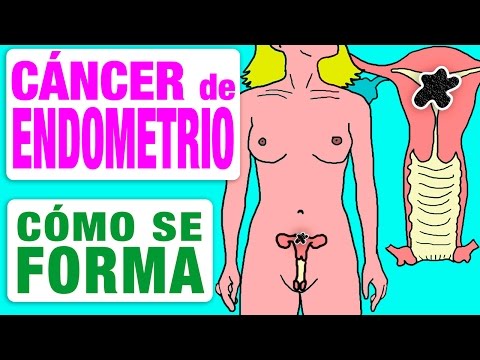 Cáncer de cuello uterino: cómo se forma
