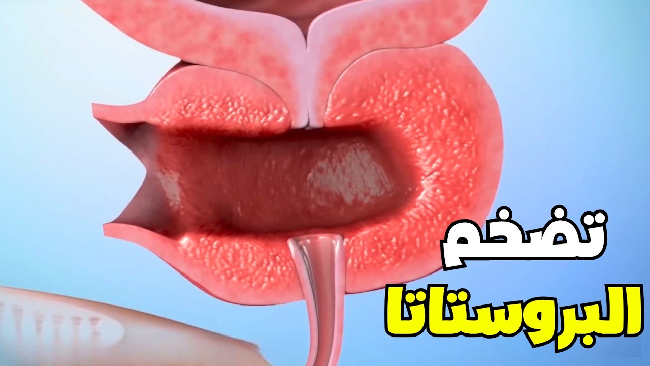 شاهد كيف يتم علاج تضخم البروستاتا بأحدث الطرق _prostate enlargement