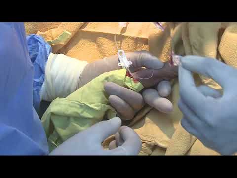 PICC Line insertion