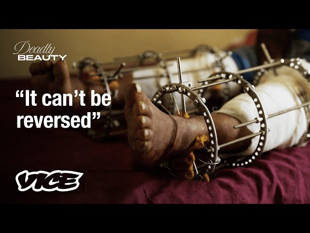 This Man Is Breaking His Legs to Grow Taller | VICE Asia