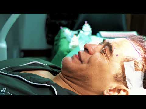 Donny Damara Hair Transplant Journey