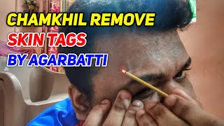 I\'m How To Removed Chamkhil Skin Tags Neck Face At Home Agarbatti | Chamkul Kaise Nikale Upay Vlog