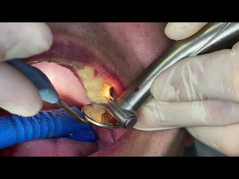 Auftrennen einer VMK -Krone mit Horico Instrumenten