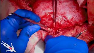 Download Lagu Explantation of Infected Aortic Endograft with Suprarenal Fixation Rahimi, MD, Ramirez Del Val, MD Thumbnail