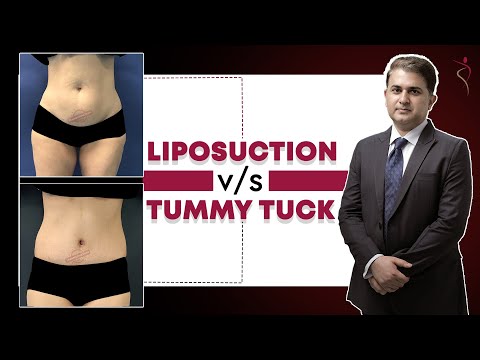 Vaser Liposelection