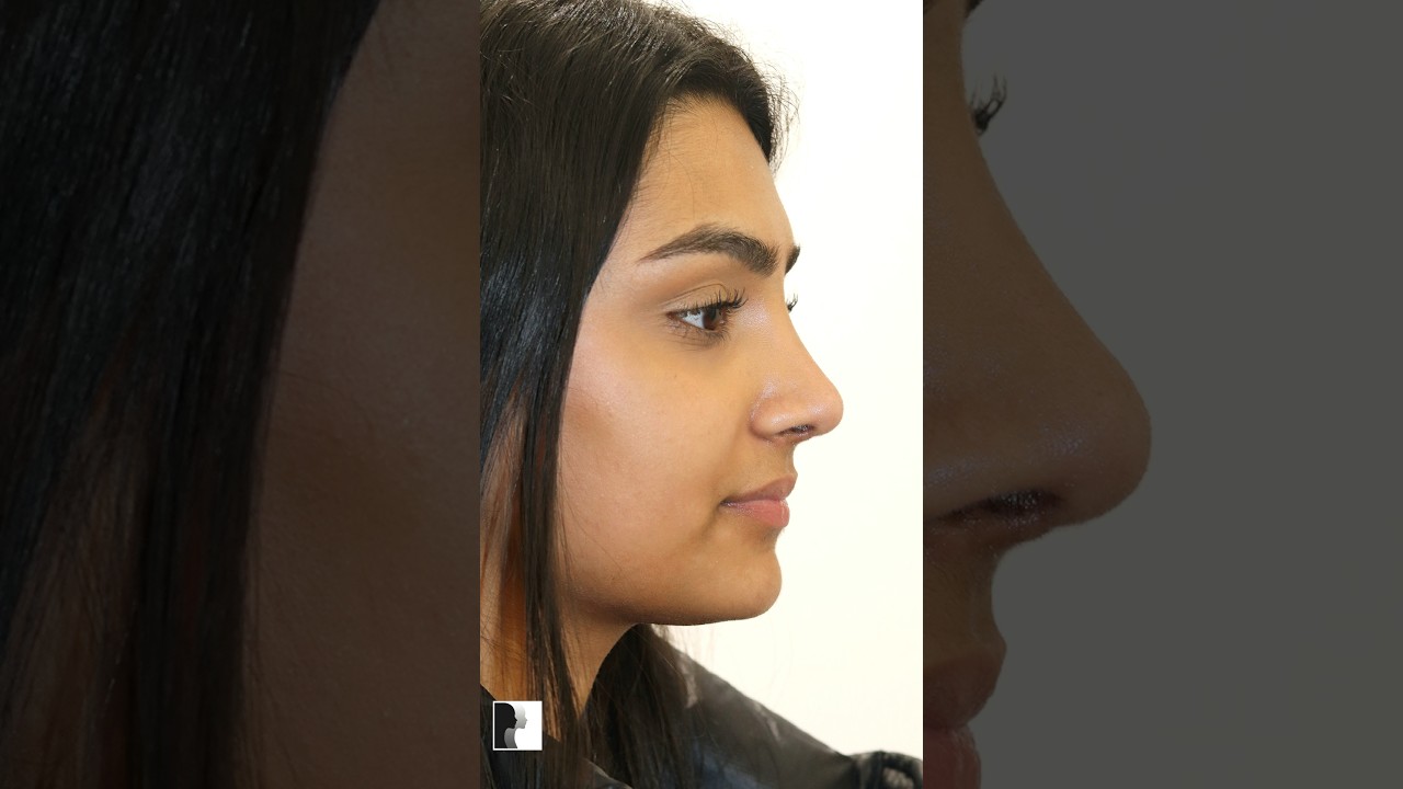 Dr. De Silva's Rhinoplasty Transformation Results!