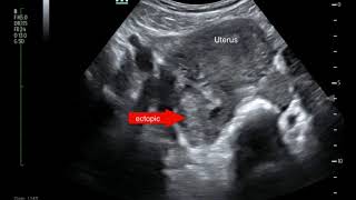 Ectopic Pregnancy, Ultrasound, Annotated  JETem 2017