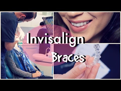 Invisalign Braces Why | What | Where | How