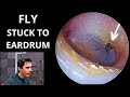 Dead Fly Stuck To Eardrum