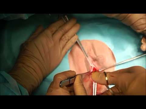 Dynamesh SIS direct soft