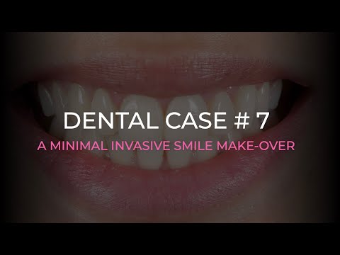 A minimal invasive smile make-over | Dental case #7