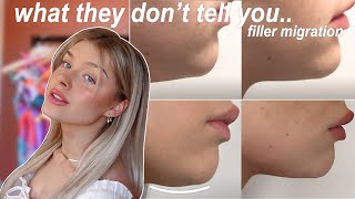 chin filler 3 years later | filler migration, what they don