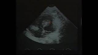 Cardiac masses 2