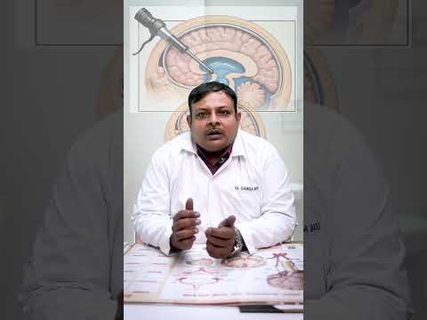 Endoscopic Third Ventriculostomy (ETV) Explained | Hydrocephalus Treatment by Dr. Garga Basu