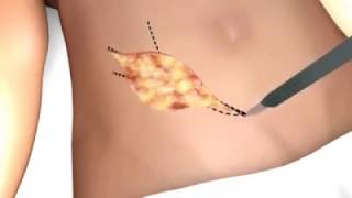 Kidney TransplantVideo In India Kidney TransplantVideo In India