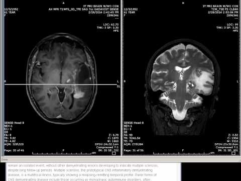Pierwotny guz mózgu i niedowidzenie połowicze jednoimienne - RM głowy z kontrastem