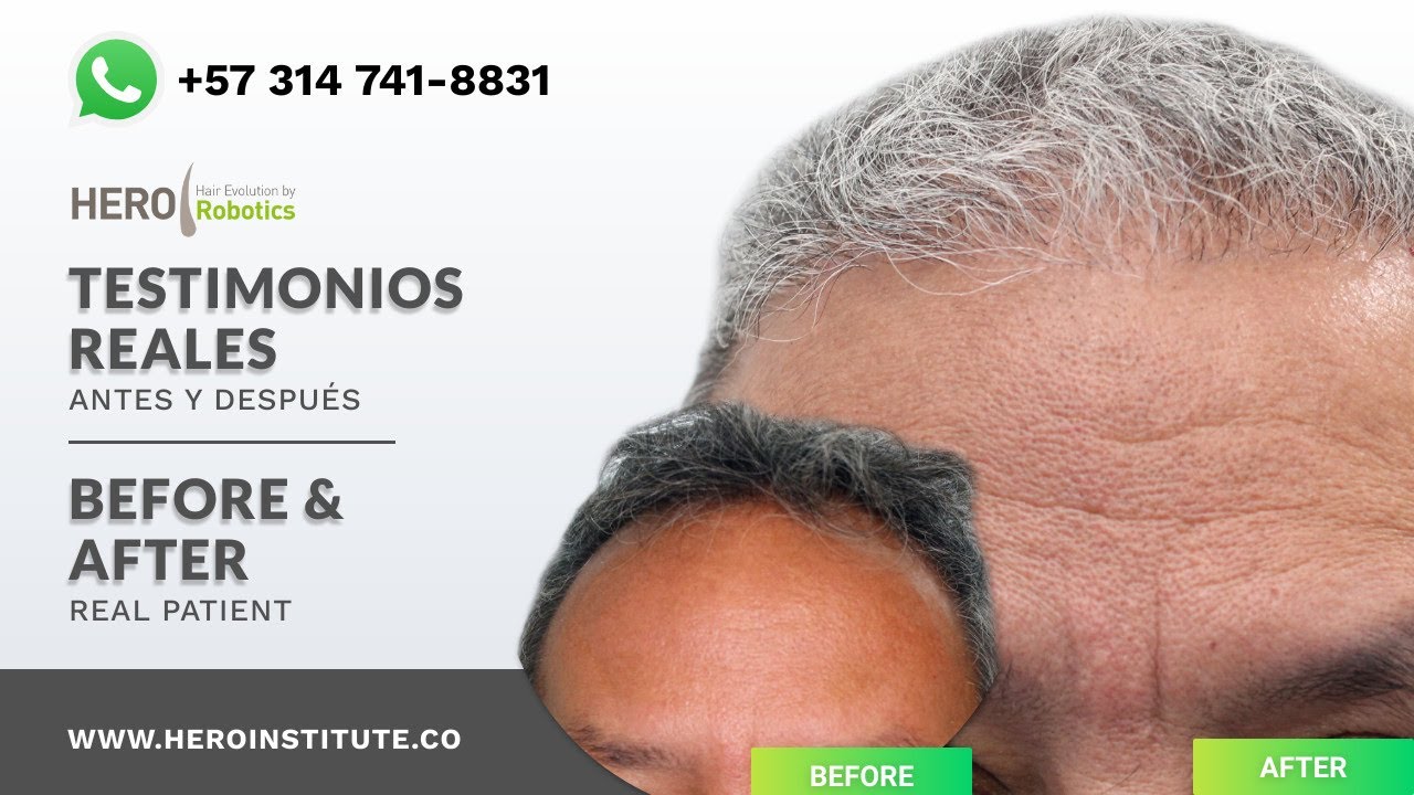 Watch ¡Trasplante de pelo entradas paciente con más de 50 años! Now ¡Trasplante de pelo entradas paciente con más de 50 años!