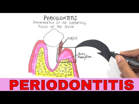 Periodontal Disease | Pathogenesis