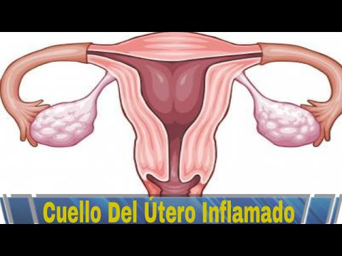 Cervicitis: conozca la enfermedad que afecta a muchas mujeres a lo largo de la vida Cervicitis: conozca la enfermedad que afecta a muchas mujeres a lo largo de la vida