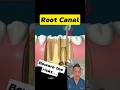 Root Canal Dangers: What Your Dentist Might Not Tell You #dentallan #dentist #shorts