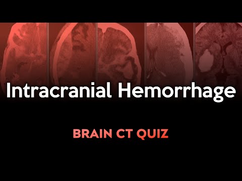 Intracranial Hemorrhage: Brain CT Quiz