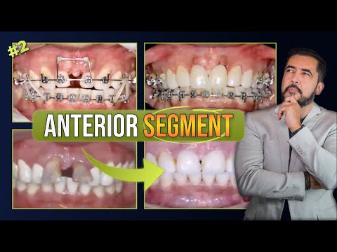 Closing space in Anterior Segment #2 | ORTHODONTIC TIPS