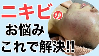 ニキビ悩みお任せください