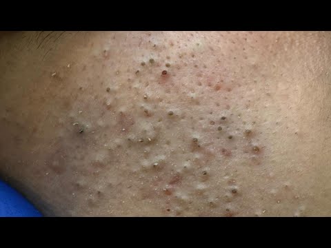 Facial Deep Cleanse — Ultimate Blackhead Removal Techniques