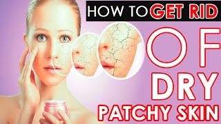 #DryPatchy - How To Get Rid Of Dry Patchy Skin - Health Wenke