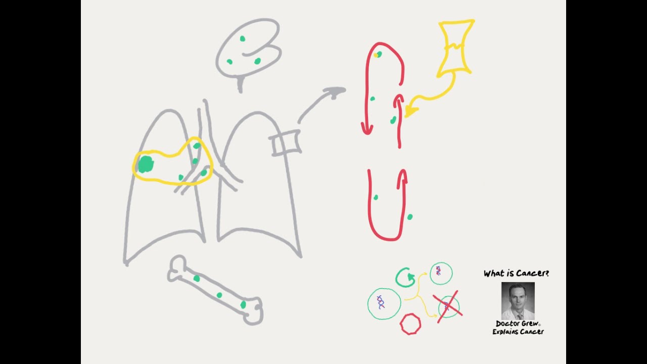 Doctor Explains How Cancer Starts, Spreads and How Cancer is Treated
